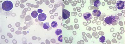Case Report: Roxadustat in Combination With Rituximab Was Used to Treat EPO-Induced Pure Red Cell Aplasia